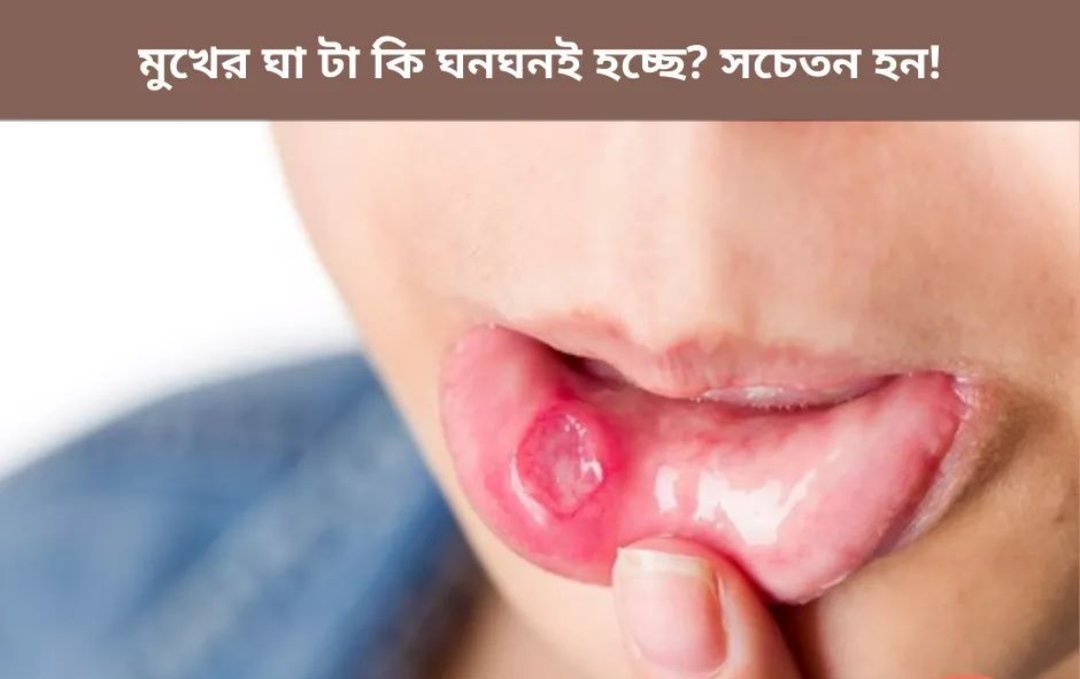 মুখগহ্বর এর আলসার (Apthous Ulcer)
